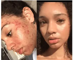Buttah Skincare Before And After