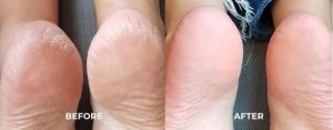 Flexitol Heel Balm Before After