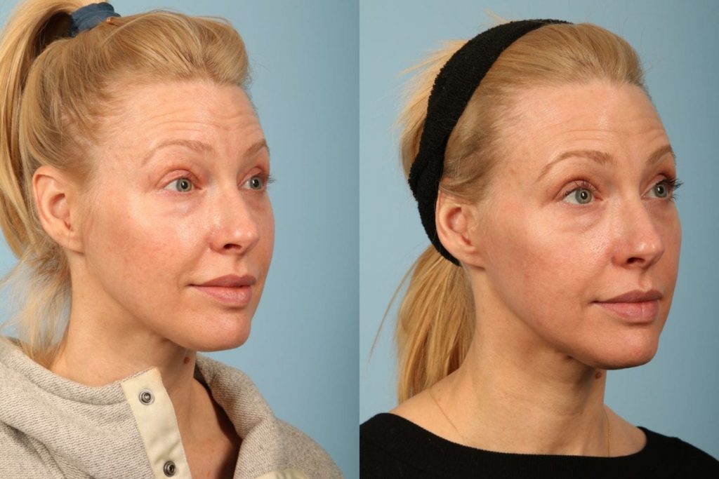 SkinMedica Before And After 