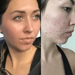 Face Reality Skincare before and after