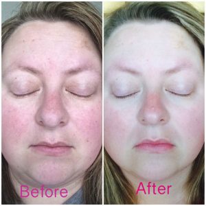 Image Skincare Before and After