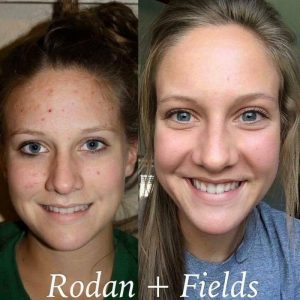 Rodan+Fields before and after