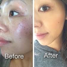 Urban Skin Rx Before and After