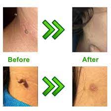 TagBand skin tag removal reviews before and after