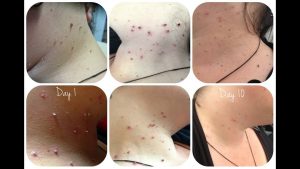 Tagband skin tag removal before and after