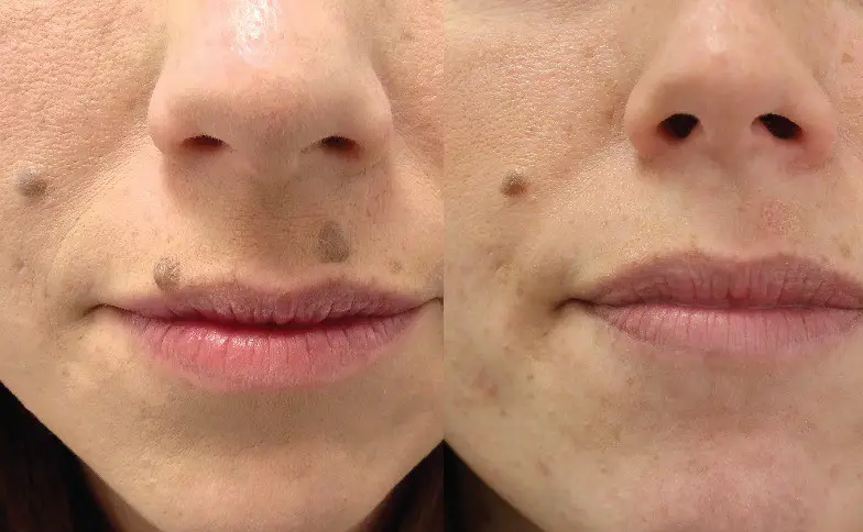 HaloDerm Before and After
