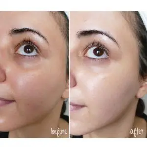 M.A.D skincare before and after