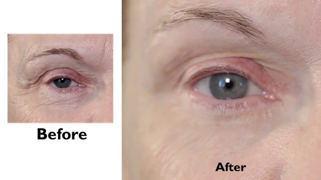 Peter Thomas Roth Eye Cream Before and After