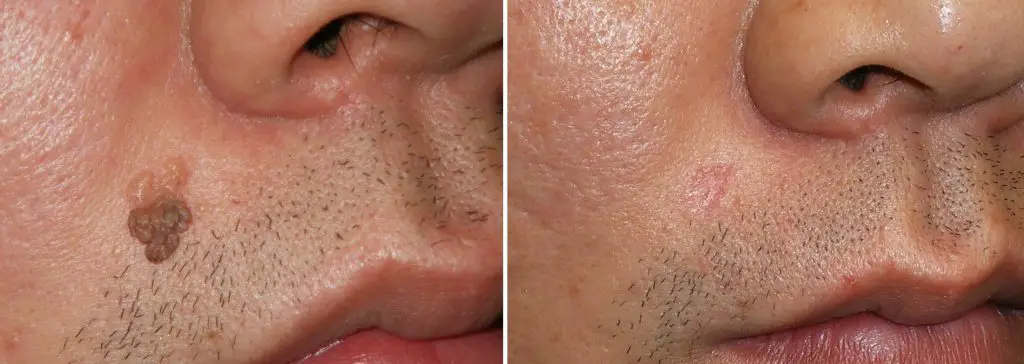 Skincell Pro before and after