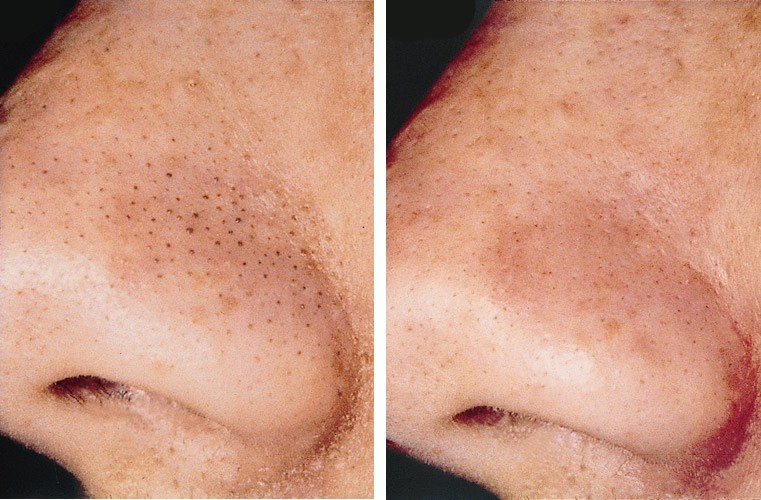 St. Ives Blackhead Clearing before and after