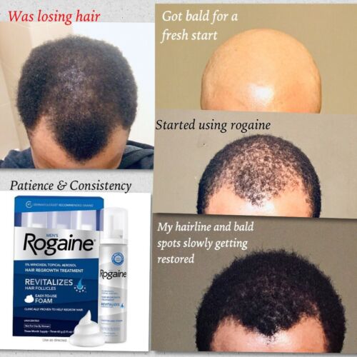 Rogaine before and after