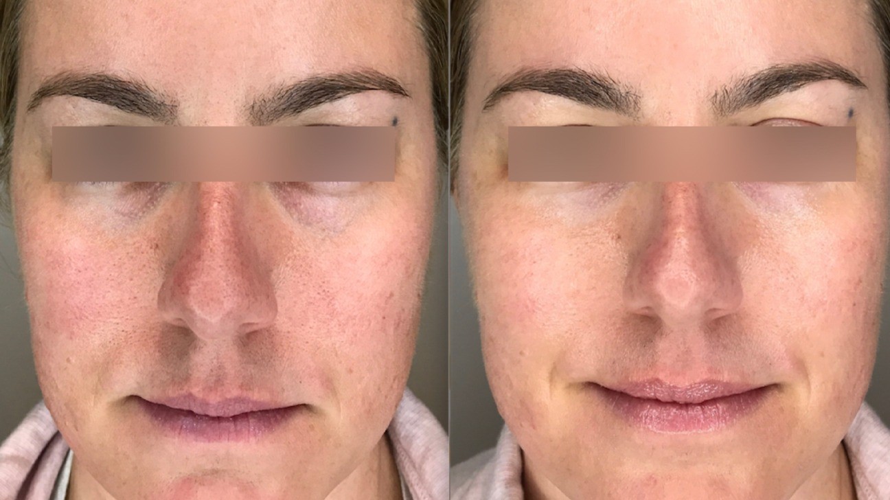 Cezaria Wrinkle Freezing Moisturizer before and after
