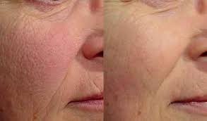 Cicatricure Gold Lift before and after