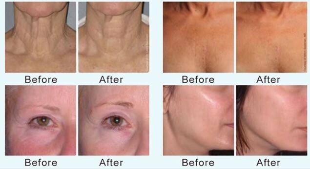 Elemis Before and after