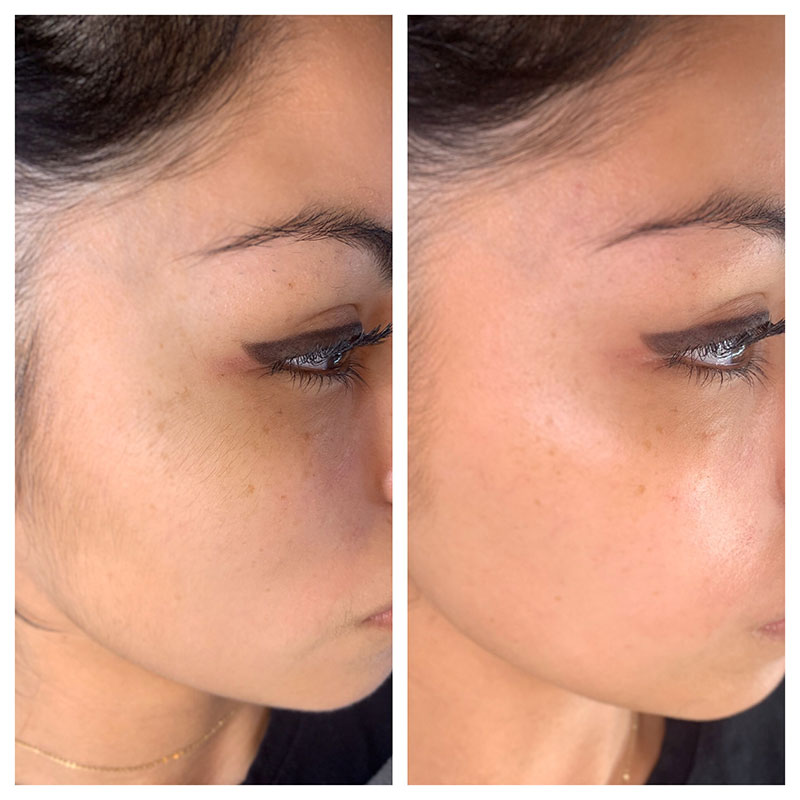 Lux Derma before and after