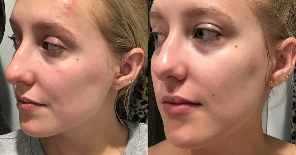 PCA Skin Before and After
