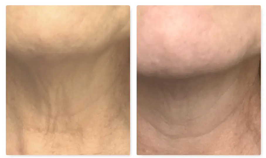 Prai Neck Cream Before And After