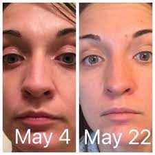 Rodan And Fields Reverse before and after