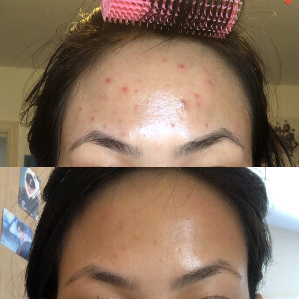 The Ordinary Glycolic Acid Toner before and after