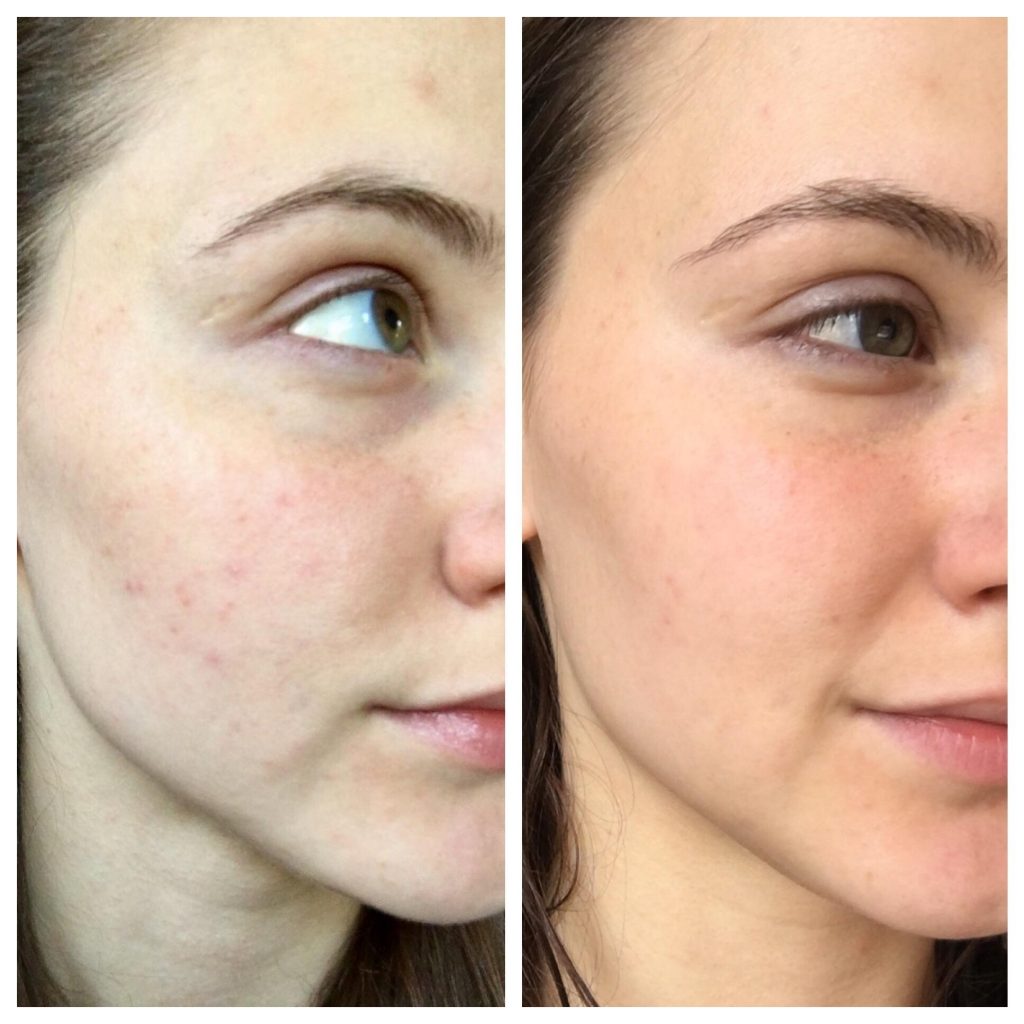 The Ordinary Glycolic Acid Toning Solution before and after