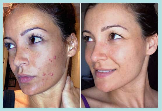 Proactiv before and after