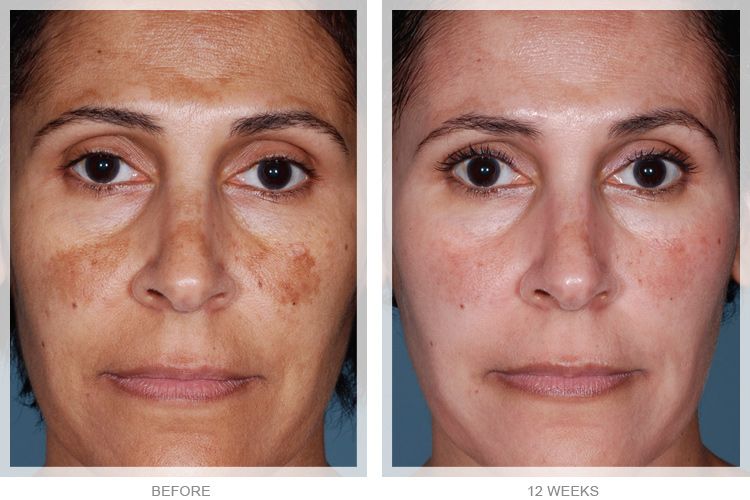 obagi nu-derm before and after