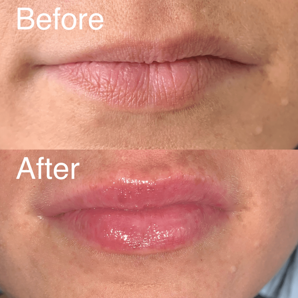 stay aesthetic lip plumper before after
