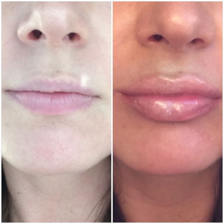 stay aesthetic lip plumper before after