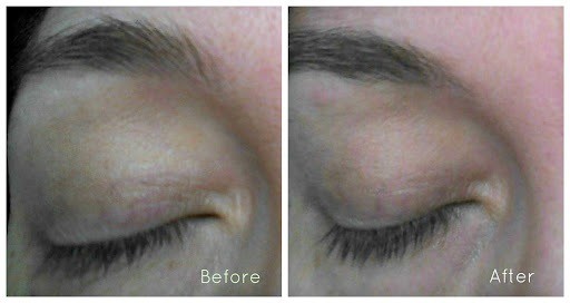 Neulash Before and After