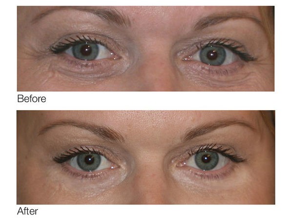 dermelect before and after