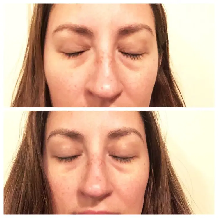Goldfaden MD Bright Eyes before and after