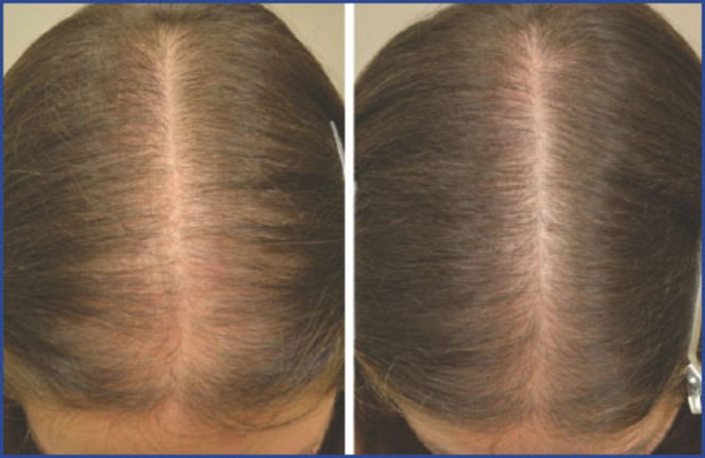 Hair Biology Thickening Treatment Before and After
