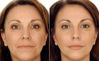 Nature Fused Anti-Aging Cream before and after