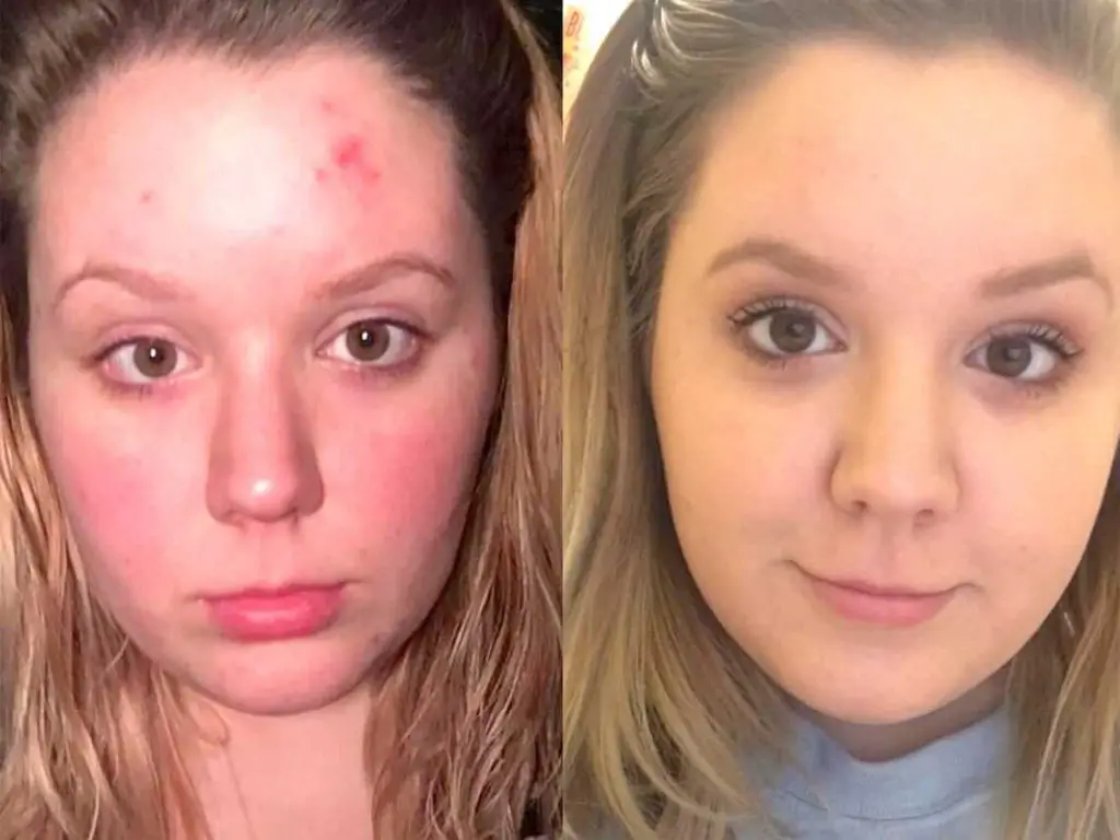 Cocokind Vitamin C Serum before and after