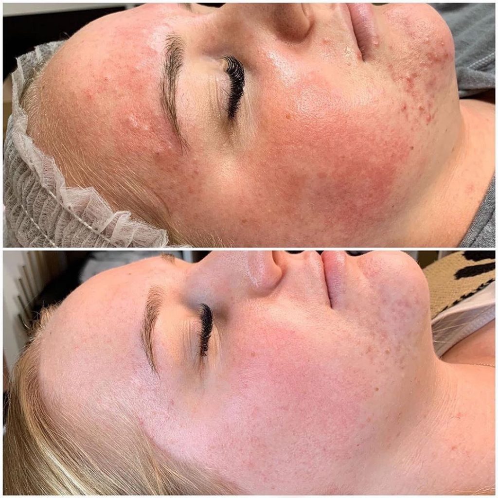 Skin Restoring Fulvic Elixir (GM32) 15 before and after
