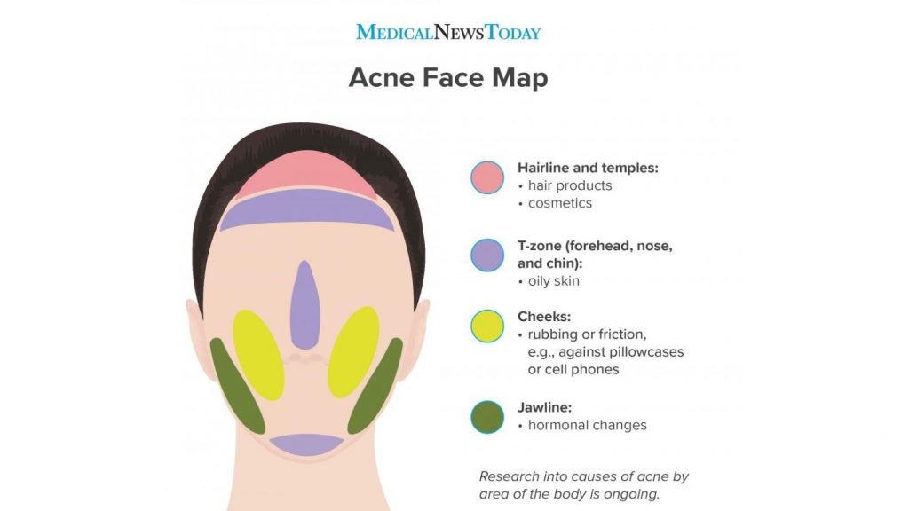 Acne Face Map