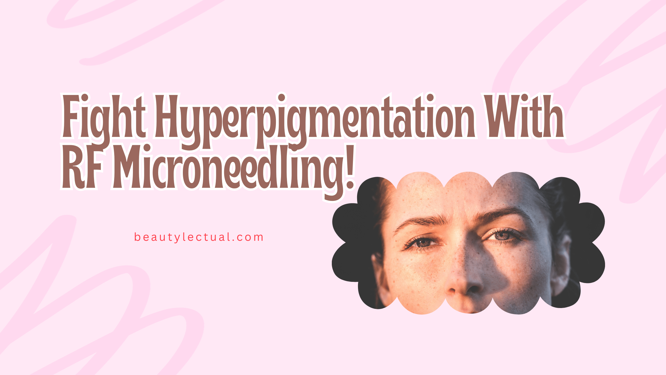RF microneedling for hyperpigmentation