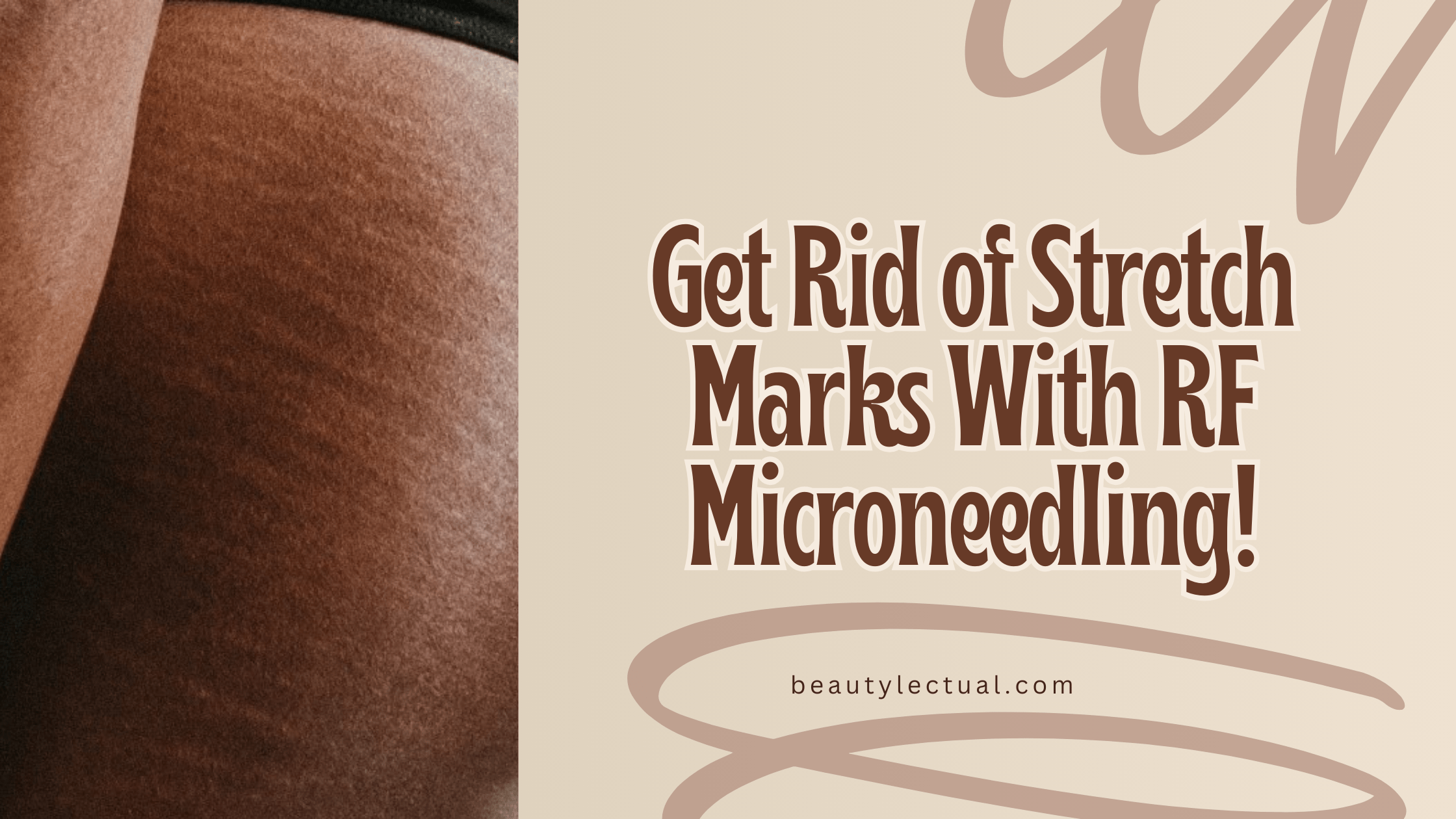 RF microneedling for stretch marks